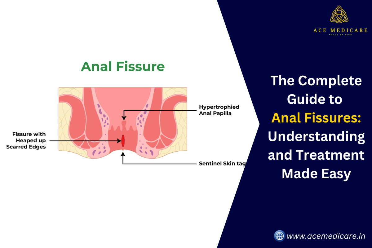 The Complete Guide to Anal Fissures: Understanding and Treatment Made Easy